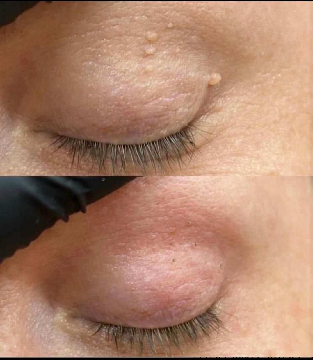 خال برداری کاملا بهداشتی وباوسایل یک بار مصرف|خدمات آرایشگری و زیبایی|قم, امامزاده ابراهیم|دیوار