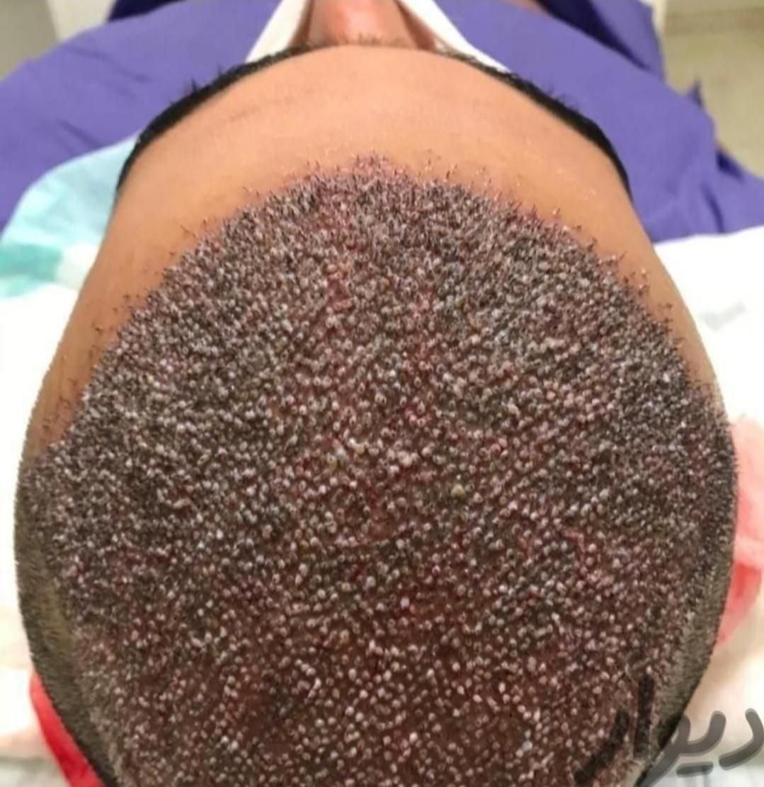 کاشت مو تراکم بالا (بدون تراشیدن سر)|خدمات آرایشگری و زیبایی|محمدشهر, |دیوار