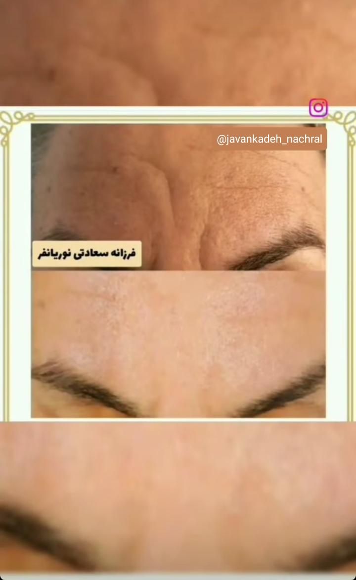 چین و چروک|آرایشی، بهداشتی، درمانی|تهران, جابری|دیوار