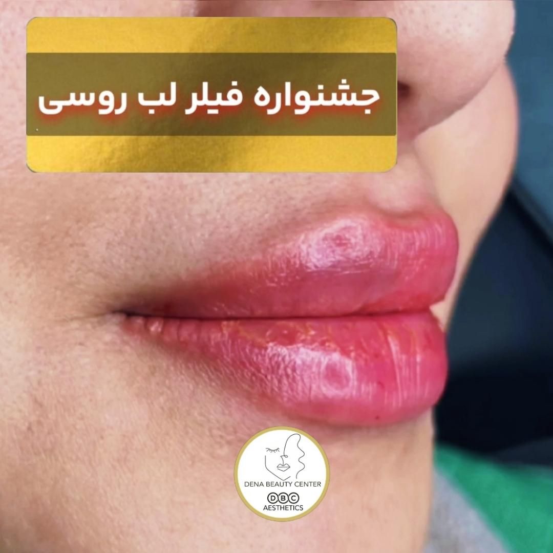 (کلینیک دنا)  فیلر لب ژل‌لب ،زاویه سازی ،طبیعی|خدمات آرایشگری و زیبایی|یاسوج, |دیوار