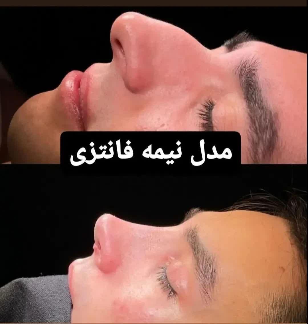 عمل بینی.لیفت|خدمات آرایشگری و زیبایی|کرج, کرج نو|دیوار