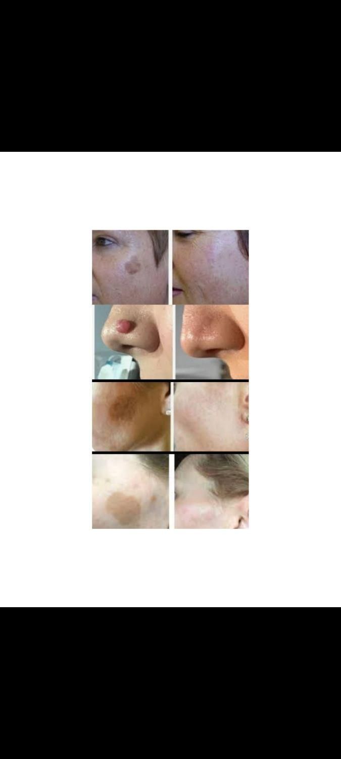 برداشتن انواع خال لک زیگیل تناسلی و...|خدمات آرایشگری و زیبایی|اصفهان, شهرک کوثر|دیوار