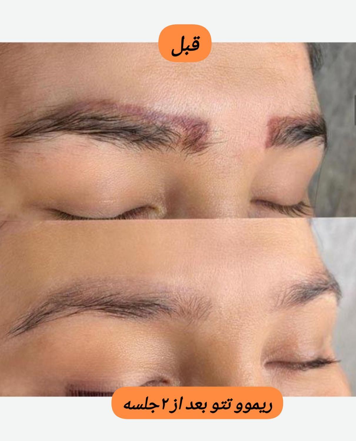 کیوسوئیچ، لیزر موهای زائد، هایفو، جوانسازی|خدمات آرایشگری و زیبایی|آبادان, |دیوار