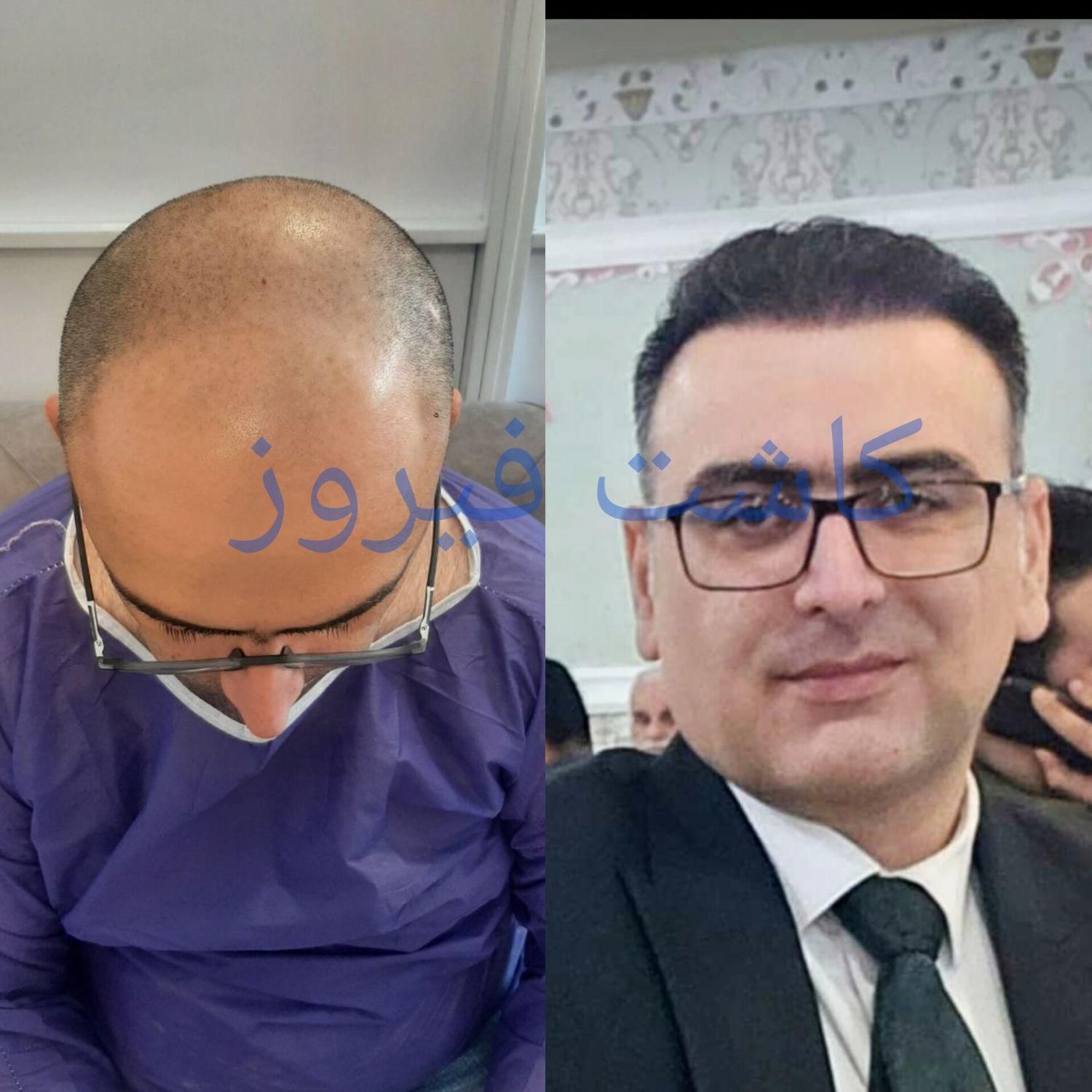 کاشت مو فول تراکم|خدمات آرایشگری و زیبایی|تهران, نارمک|دیوار
