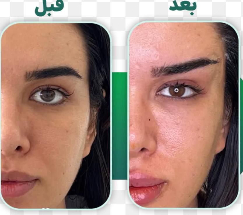 تخفیف ویژه تا ۶ شهریور  فیلربادی سینه بیکینی باسن|خدمات آرایشگری و زیبایی|تهران, دارآباد|دیوار