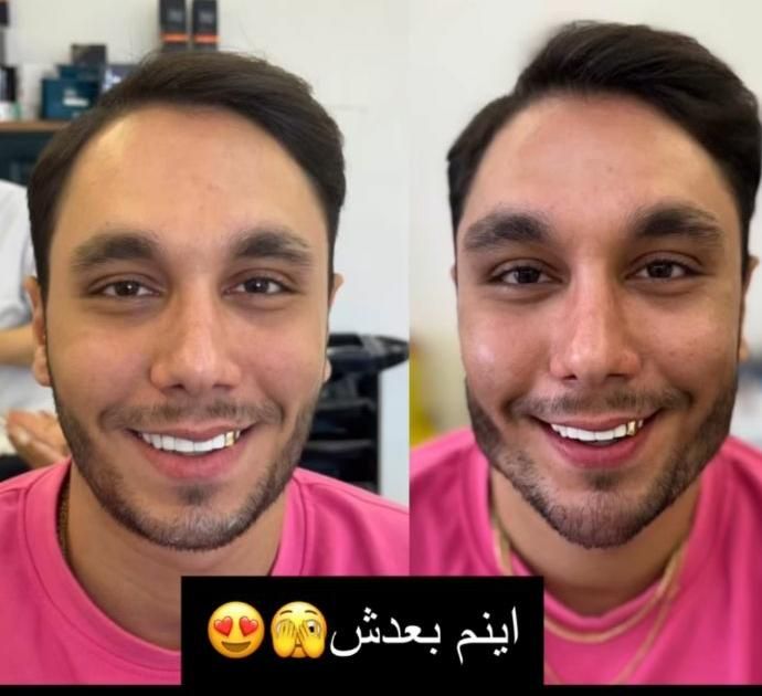 تزریق ژل بوتاکس لیفت صورت وشقیقه آنزیم مزو|خدمات آرایشگری و زیبایی|تهران, صادقیه|دیوار