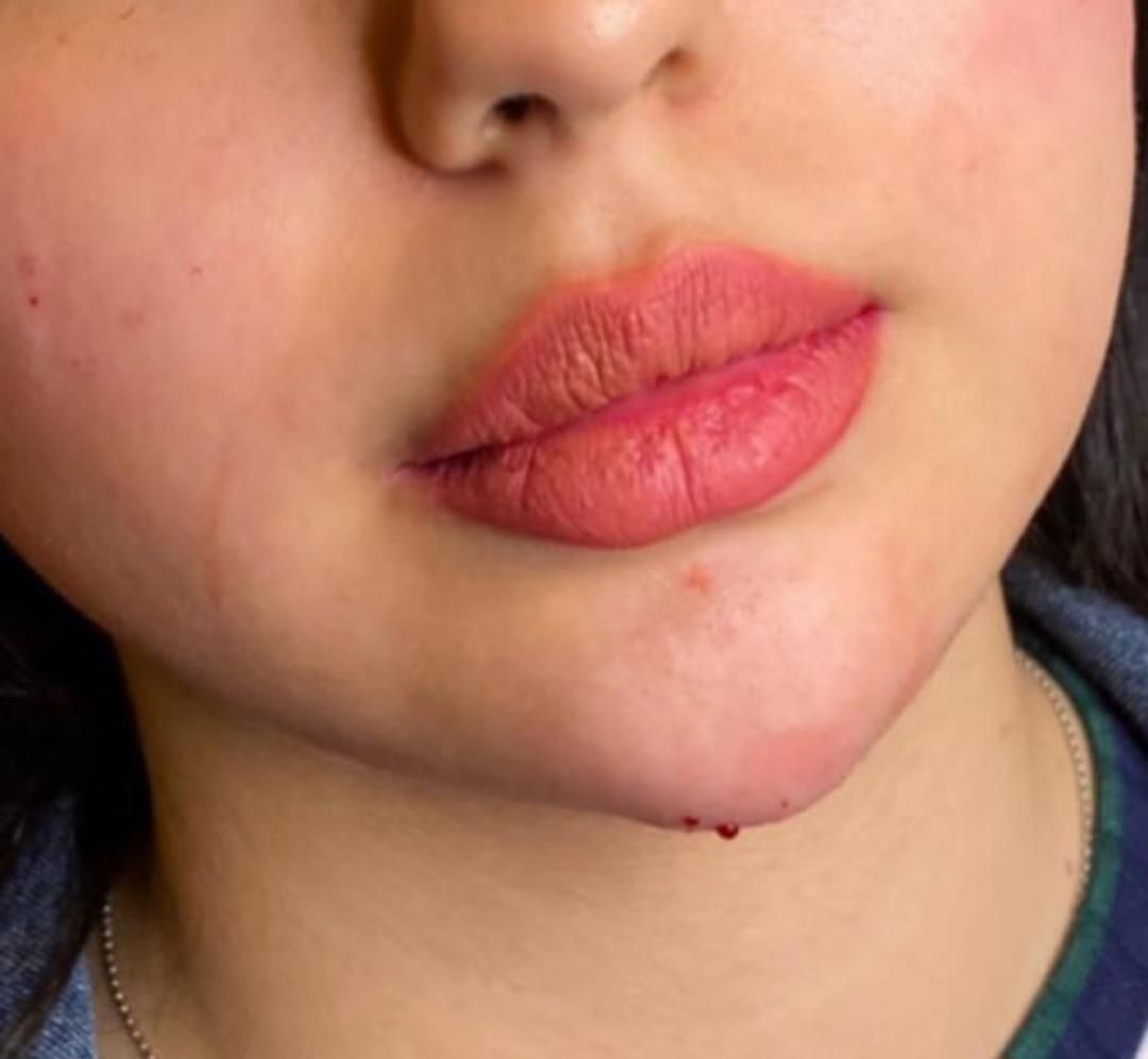 جشنواره تزریق ژل و بوتاکس مزوتراپی مزوژل|خدمات آرایشگری و زیبایی|شیراز, تحویلی|دیوار