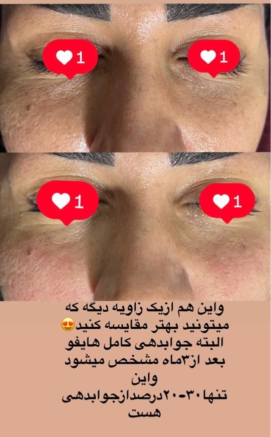 لیزر co2 فراکشنال و هایفوی پزشکی نه رومیزی|خدمات آرایشگری و زیبایی|اهواز, کیانپارس |دیوار