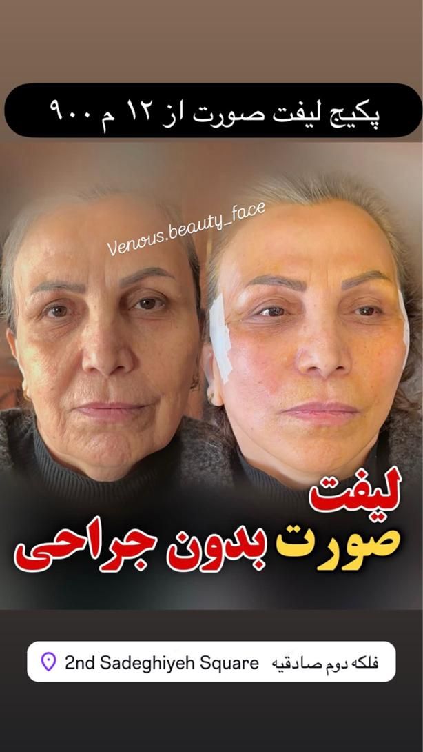 جشنواره عیدانه کلینیک50%تزریق ژللب M بوتاکس لیزر|خدمات آرایشگری و زیبایی|تهران, شهرآرا|دیوار