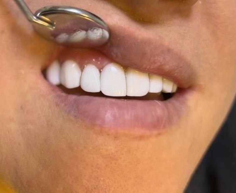 کامپوزیت دندان|خدمات آرایشگری و زیبایی|اسلام‌شهر, شهرک مهدیه|دیوار