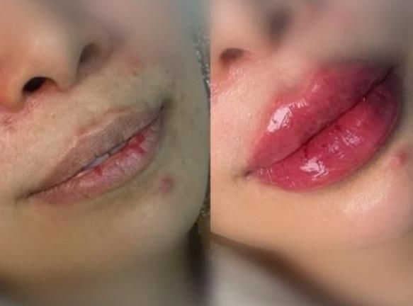 تزریق ژل فیلر بوتاکس مزوژل|خدمات آرایشگری و زیبایی|مشهد, طبرسی شمالی|دیوار