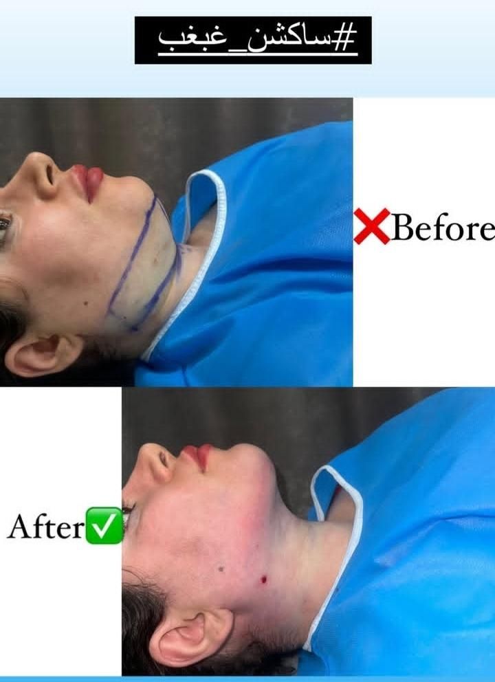 تزریق چربی فیلربادی تزریق ژل در مطب پزشک|خدمات آرایشگری و زیبایی|کرمانشاه, |دیوار
