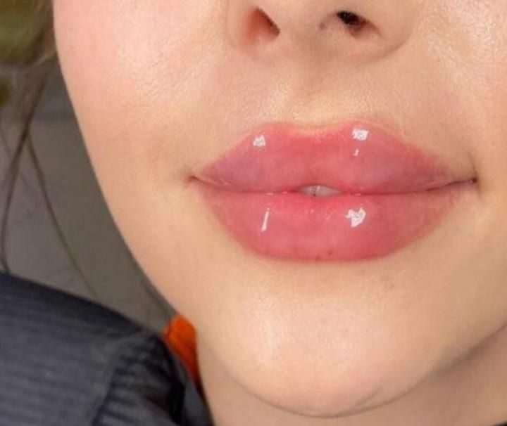 بوتاکس،تزریق ژل،مزوزیرچشم وصورت ،پرسینگ محمدشهر|خدمات آرایشگری و زیبایی|محمدشهر, |دیوار