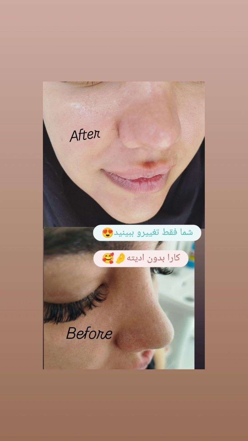 فیشیال تخصصی پوست|خدمات آرایشگری و زیبایی|گلبهار, |دیوار