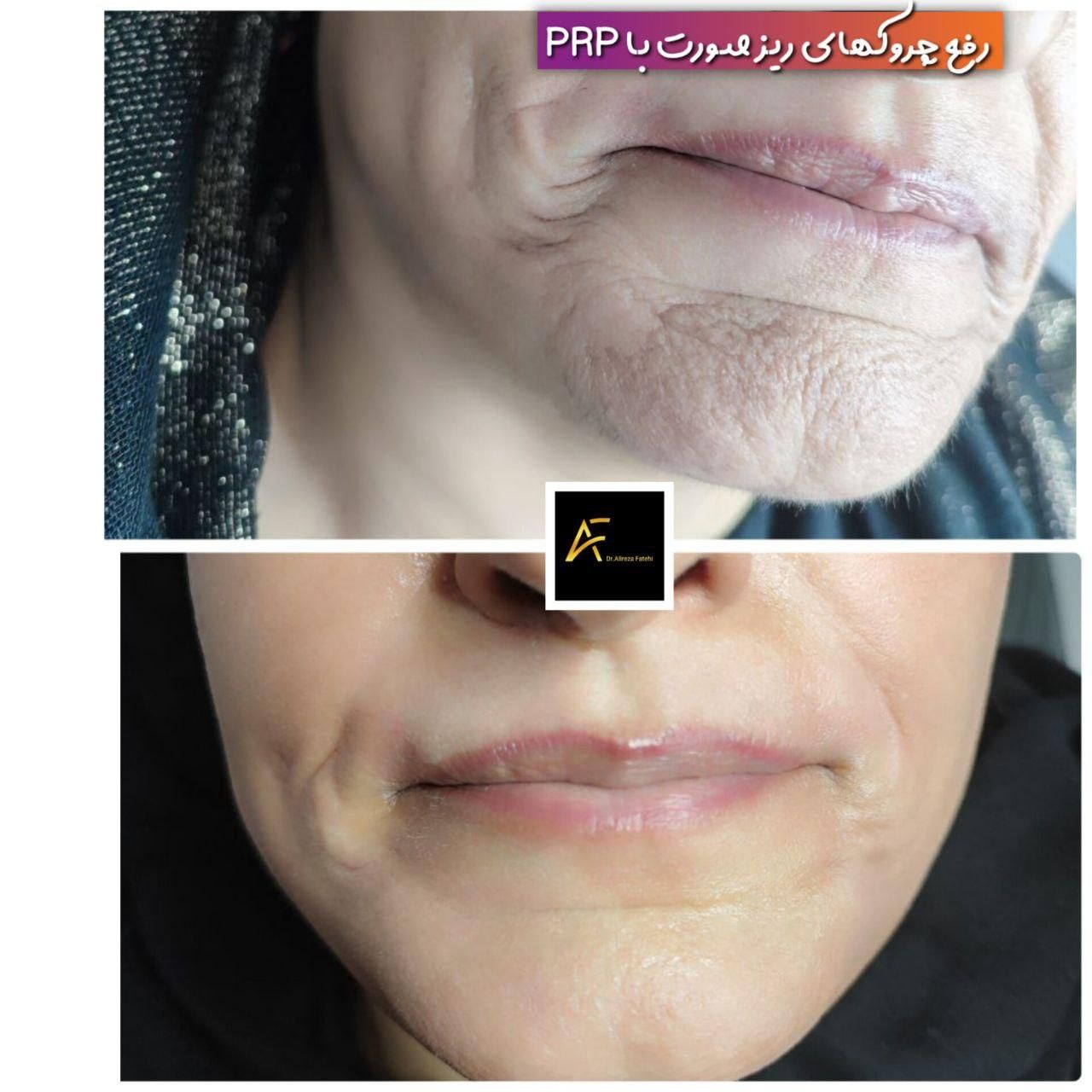 جشنواره فیلر ژل بوتاکس prpمزوتراپی لیزر توسط پزشک|خدمات آرایشگری و زیبایی|کرمان, |دیوار