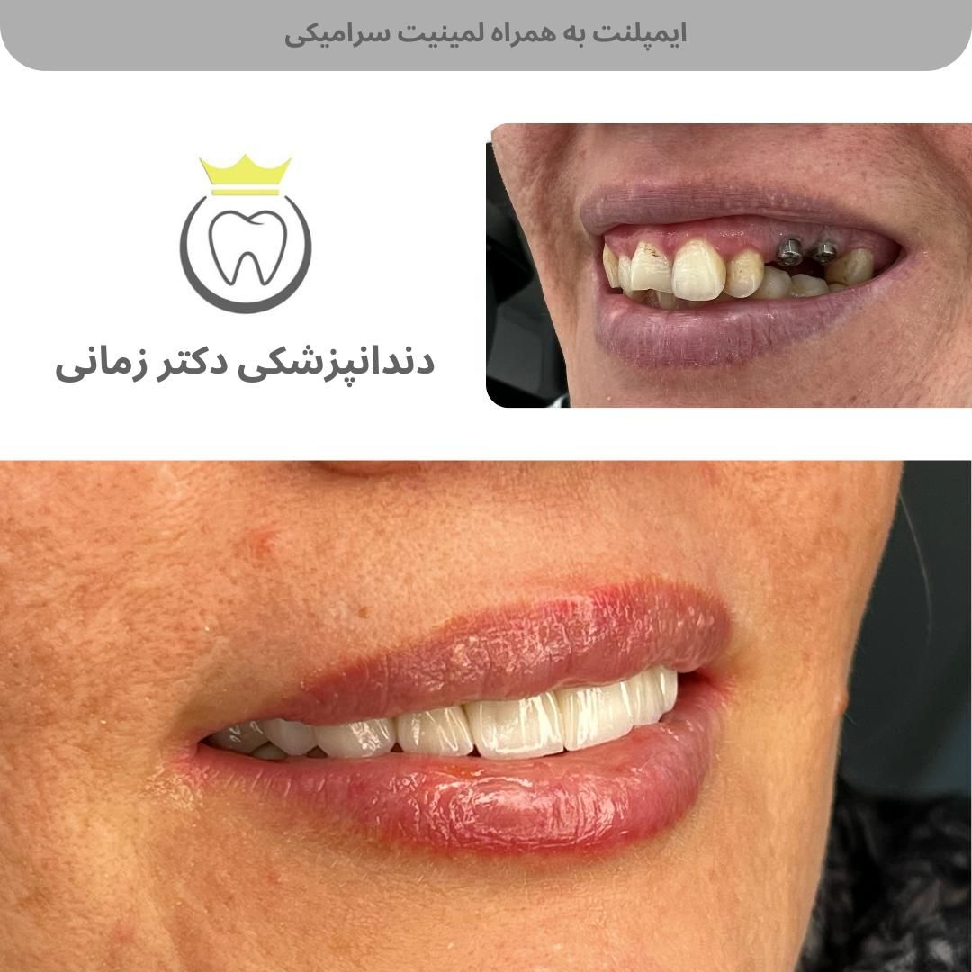 ایمپلنت دیجیتال با اقساط بلند مدت|خدمات آرایشگری و زیبایی|تهران, امیریه|دیوار