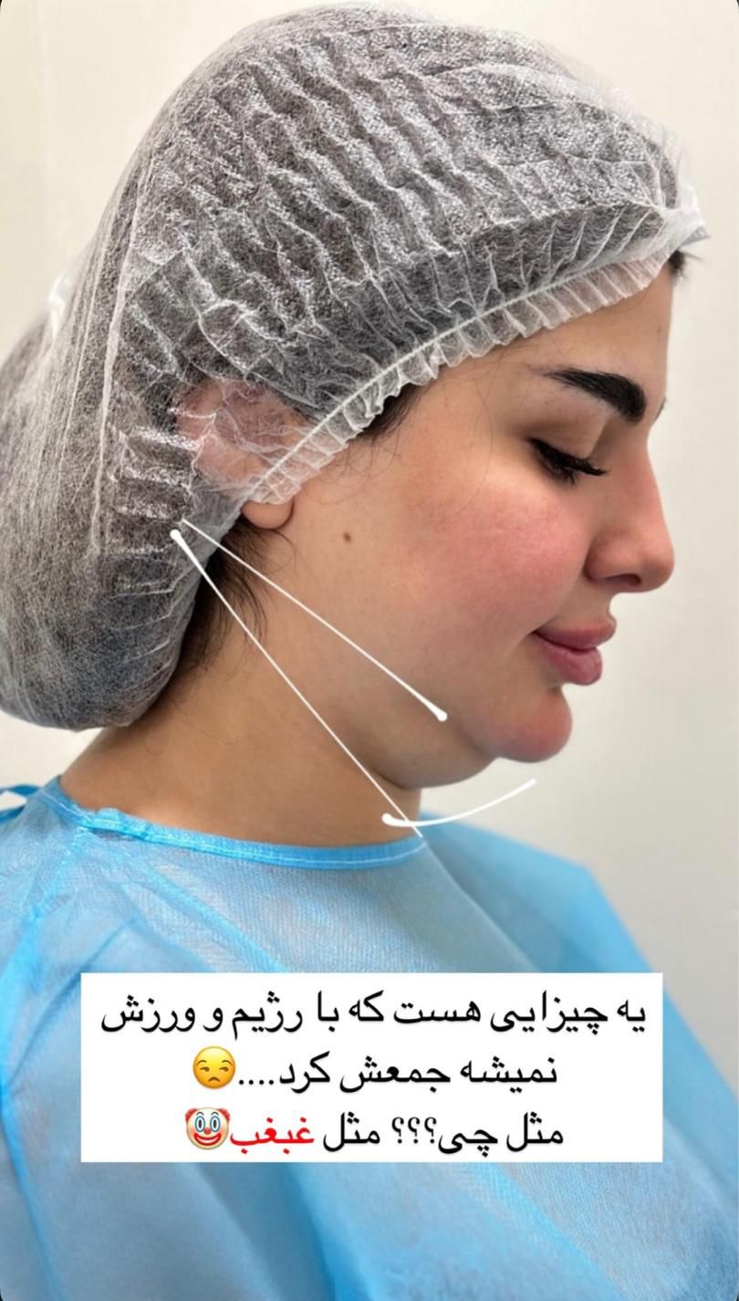 تخفیف تابستانه و استثنایی لیپو ساکشن و لیپو غعبغب|خدمات آرایشگری و زیبایی|تهران, تهرانپارس غربی|دیوار