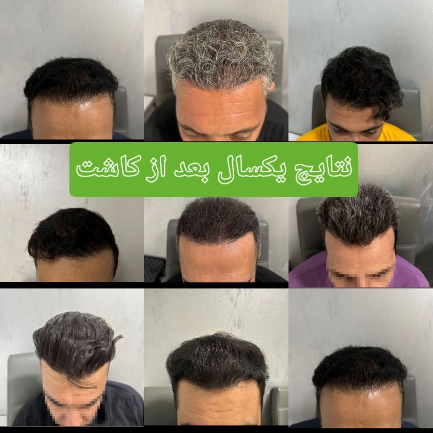 کاشت مو تراکم بالا (بدون تراشیدن سر)|خدمات آرایشگری و زیبایی|محمدشهر, |دیوار