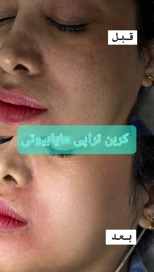 روشن کننده صورت بیکینی ،کربن تراپی تخصصی مابیوتی|خدمات آرایشگری و زیبایی|یاسوج, |دیوار