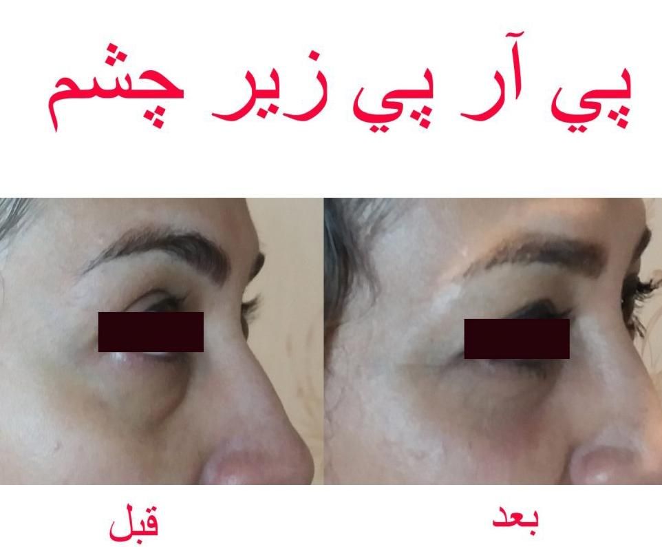 (پی آر پی بدون درد) رشد مجدد مو ،  جوانسازی صورت|خدمات آرایشگری و زیبایی|اهواز, زیتون کارمندی|دیوار