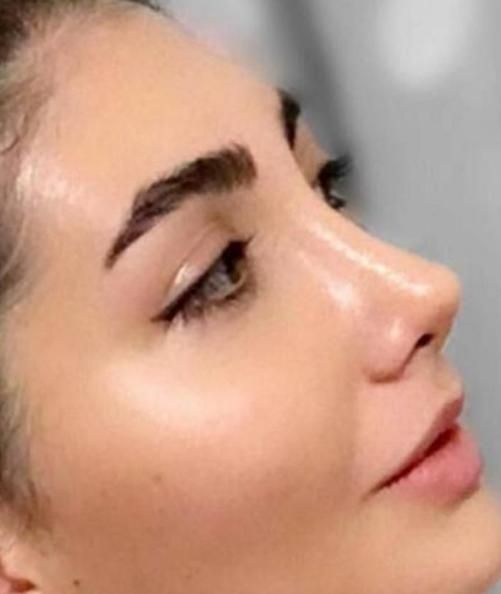 جراحی و عمل بینی/ لیفت صورت در کرج و تهران|خدمات آرایشگری و زیبایی|کرج, جهان‌شهر|دیوار