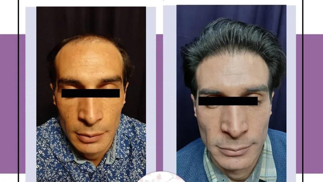 کاشت مو پرتراکم اقساطی با پرداخت 4میلیون تومان|خدمات آرایشگری و زیبایی|اصفهان, میرعماد|دیوار