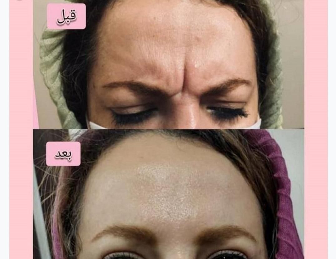 چربی بوتاکس ساکشن غبغب ژل مزو PRPتوسط پزشک مجرب|خدمات آرایشگری و زیبایی|زاهدان, |دیوار