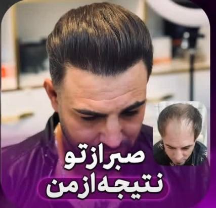 کاشت مو ابرو ریش سیبیل در مشهد توسط متخصص پوست|خدمات آرایشگری و زیبایی|مشهد, ملک‌آباد|دیوار