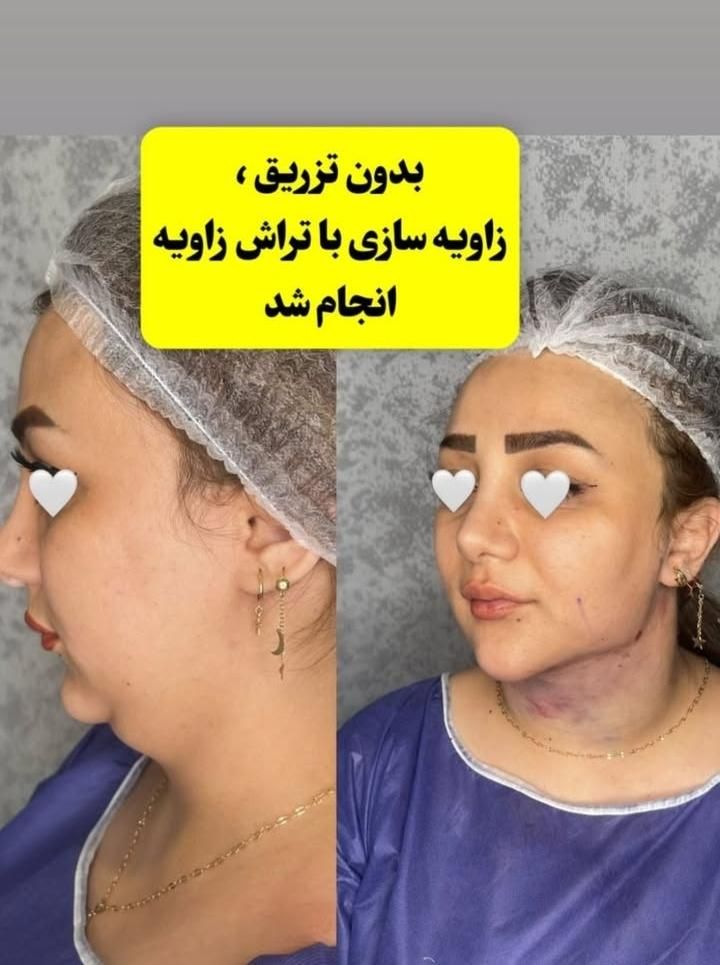 تزریق چربی فیلربادی تزریق ژل در مطب پزشک|خدمات آرایشگری و زیبایی|کرمانشاه, |دیوار