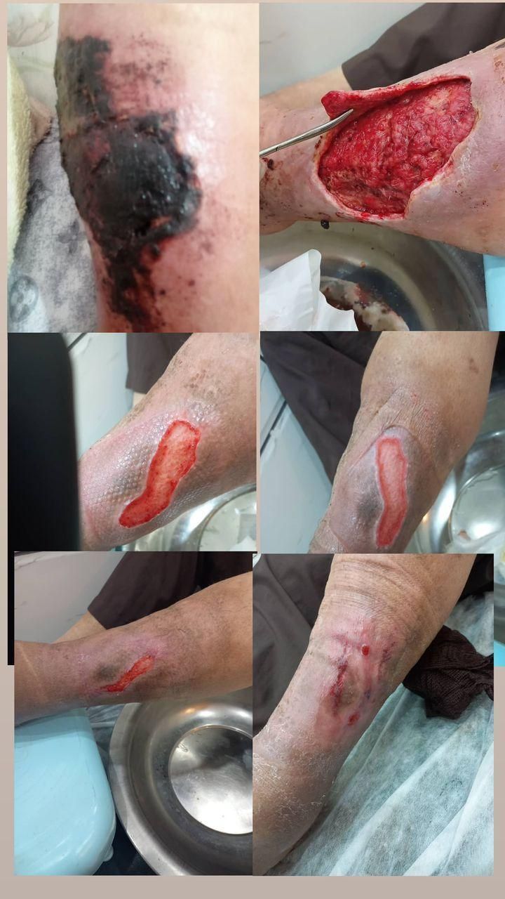 کارشناس درمانگر تخصصی زخم ،مراقب و پرستار در منزل|خدمات آرایشگری و زیبایی|مشهد, وکیل‌آباد|دیوار