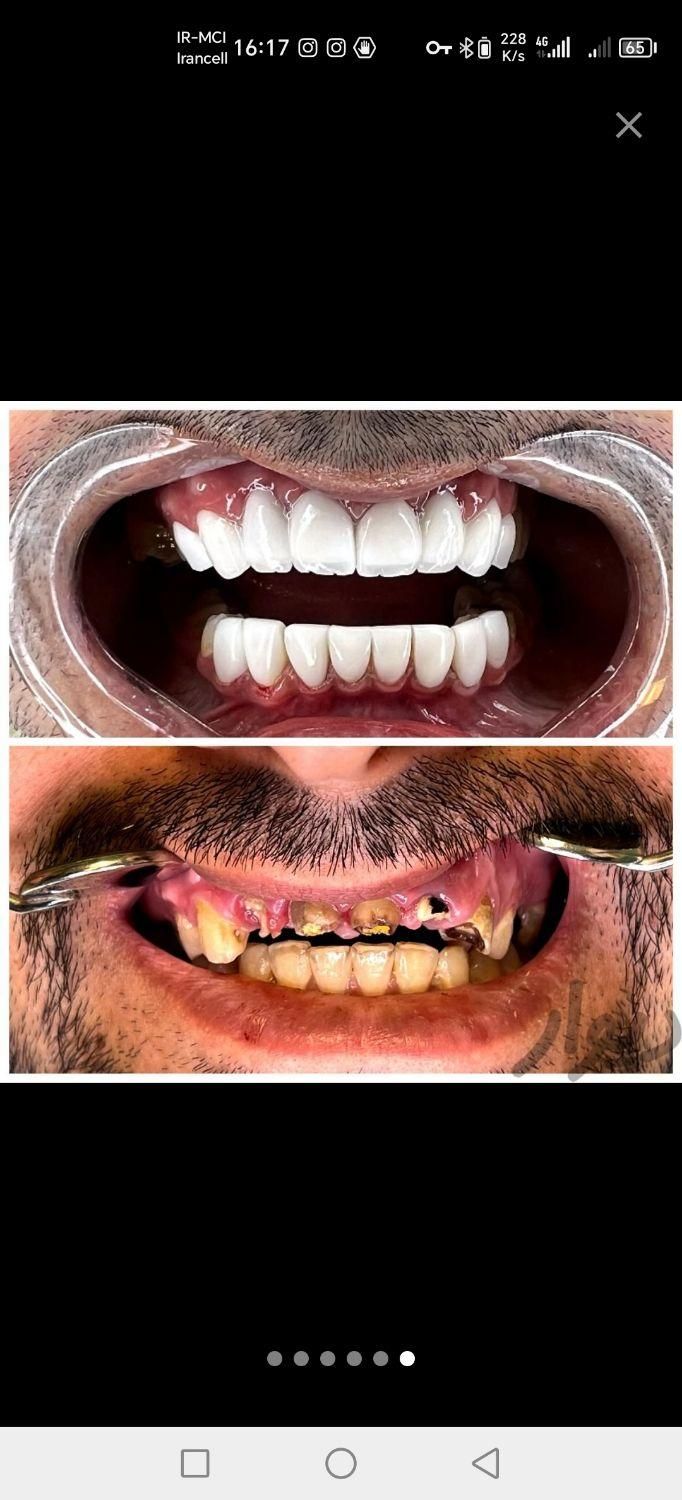 روکش دندان زیرکونیا مناسب|خدمات آرایشگری و زیبایی|تهران, افسریه|دیوار