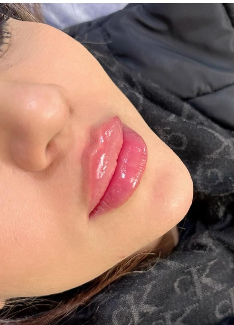 تزریق ژل بوتاکس توسط پزشک|خدمات آرایشگری و زیبایی|کرمانشاه, |دیوار