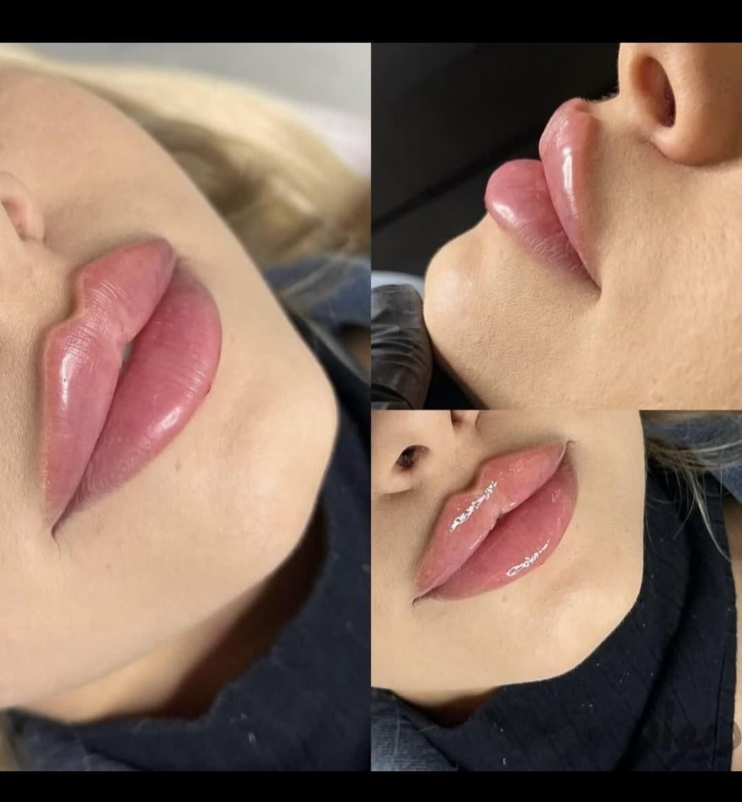 لیزرتیتانیوم،ژل لب فول فیس فیشیال مزو هایفو بوتاکس|خدمات آرایشگری و زیبایی|مشهد, آزادشهر|دیوار