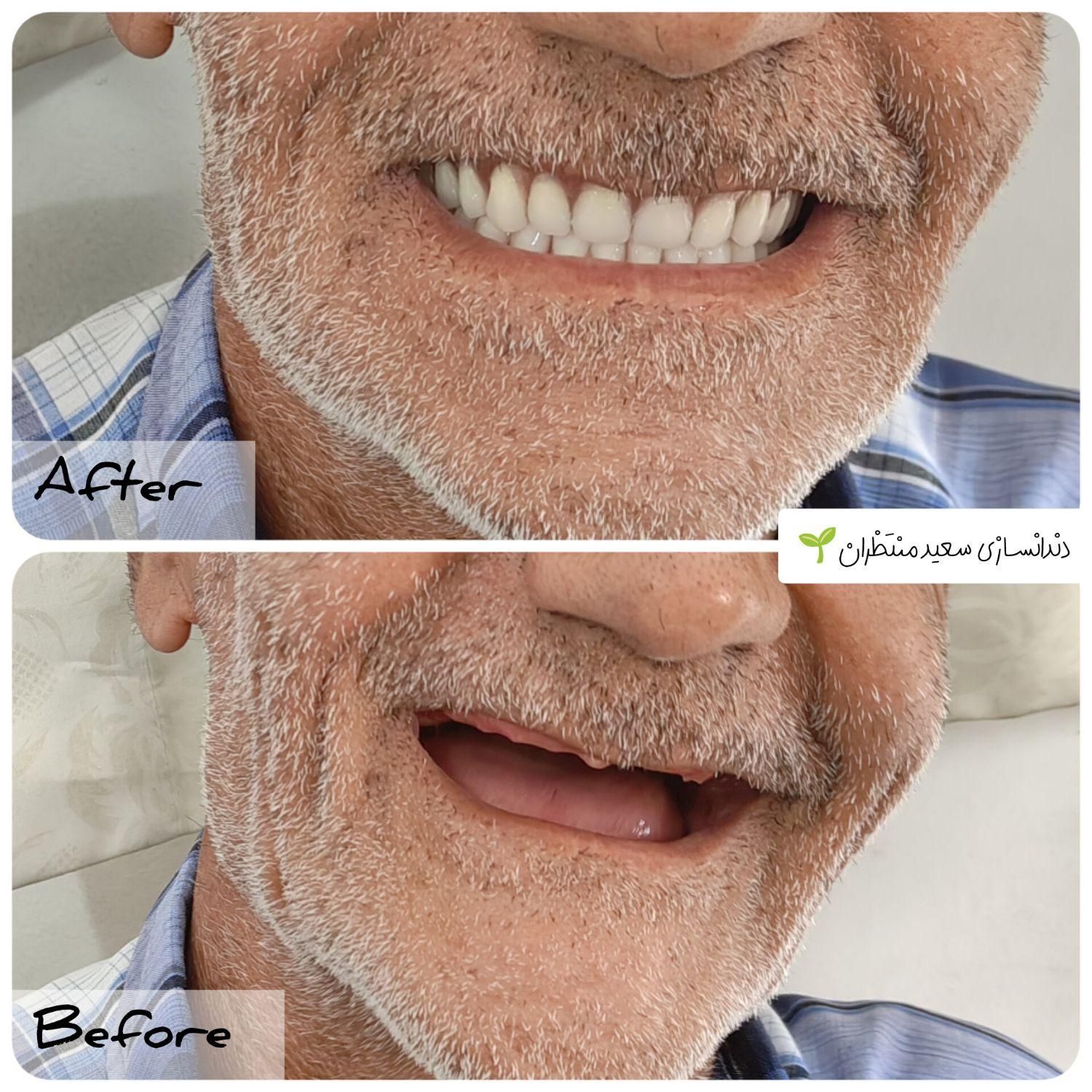 دندان مصنوعی/ دندانسازی ضمانتی/بیش ازنیم قرن تجربه|خدمات آرایشگری و زیبایی|مشهد, کوشش|دیوار