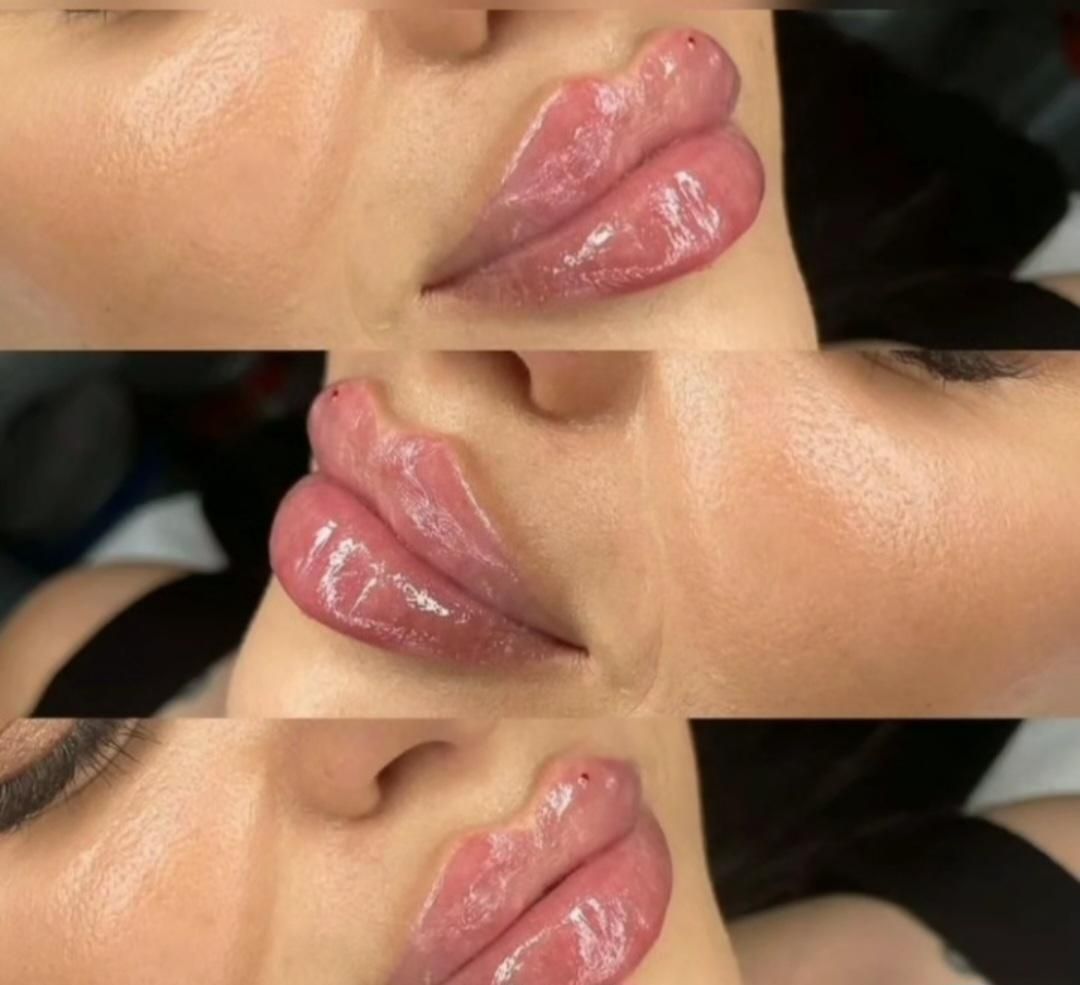 تزریق ژل لب صورت فیلر بوتاکس میکرونیلدینگ مزوتراپی|خدمات آرایشگری و زیبایی|شیراز, شهرک گلستان|دیوار