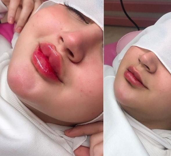 جشنواره بهاره ژل و بوتاکس آنزیم لیزر مزوتوسط پزشک|خدمات آرایشگری و زیبایی|کرج, جهان‌شهر|دیوار