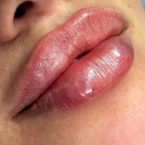 تزیق فیلروبوتاکس لیزر موهای زائد هایفو خالبرداری|خدمات آرایشگری و زیبایی|بوشهر, |دیوار