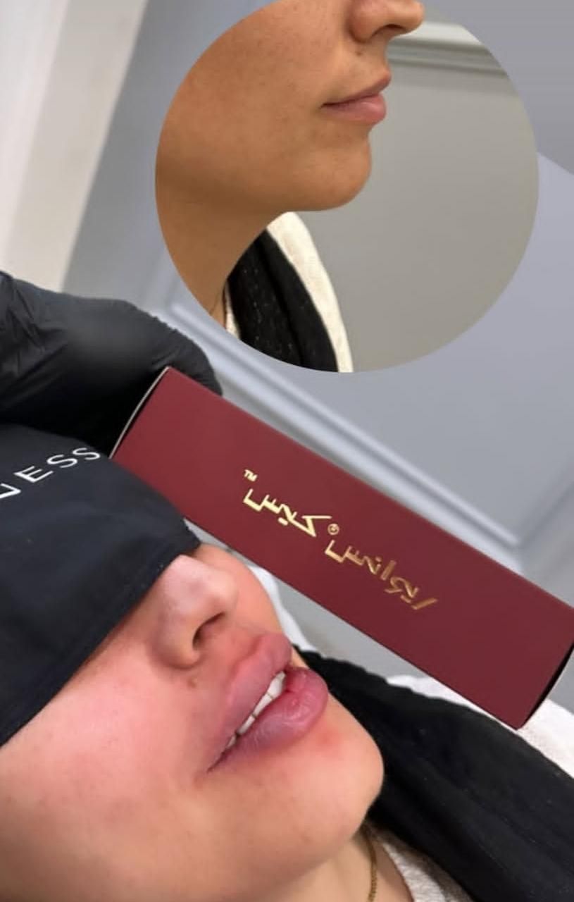 تزریق انواع ژل و بوتاکس مزوتراپی انزیم تراپی|خدمات آرایشگری و زیبایی|تهران, گیشا|دیوار