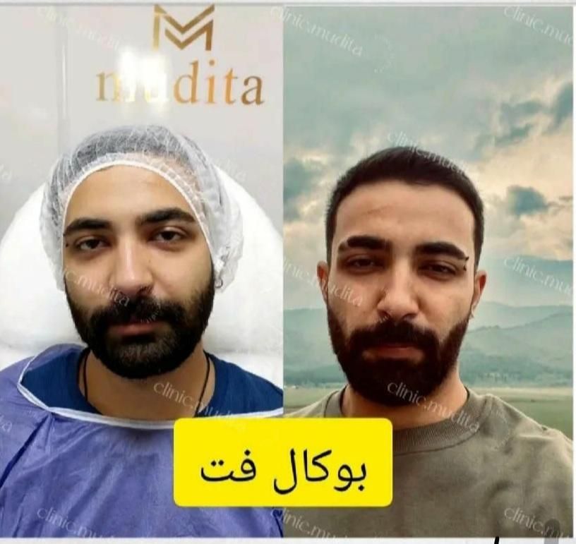 بوکالفت/ساکشن غبغب/ساکشن شکم/تزریق چربی باسن/فیلر|خدمات آرایشگری و زیبایی|تهران, صادقیه|دیوار