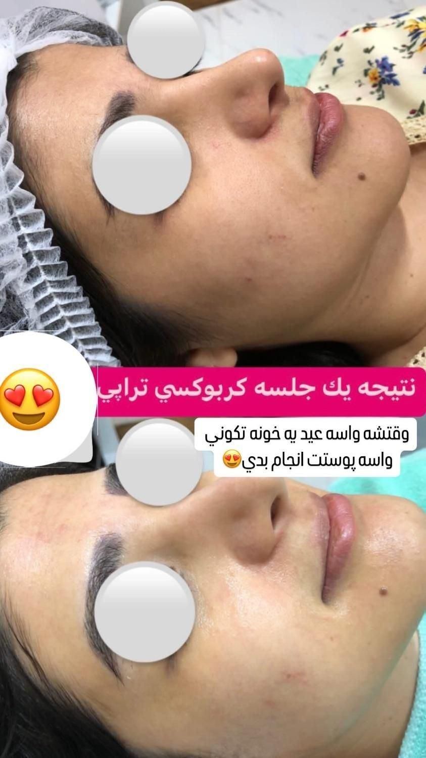 میکرونیدلینگ کربوکسی تراپی co2 (سفید کننده پوست )|خدمات آرایشگری و زیبایی|یزد, |دیوار