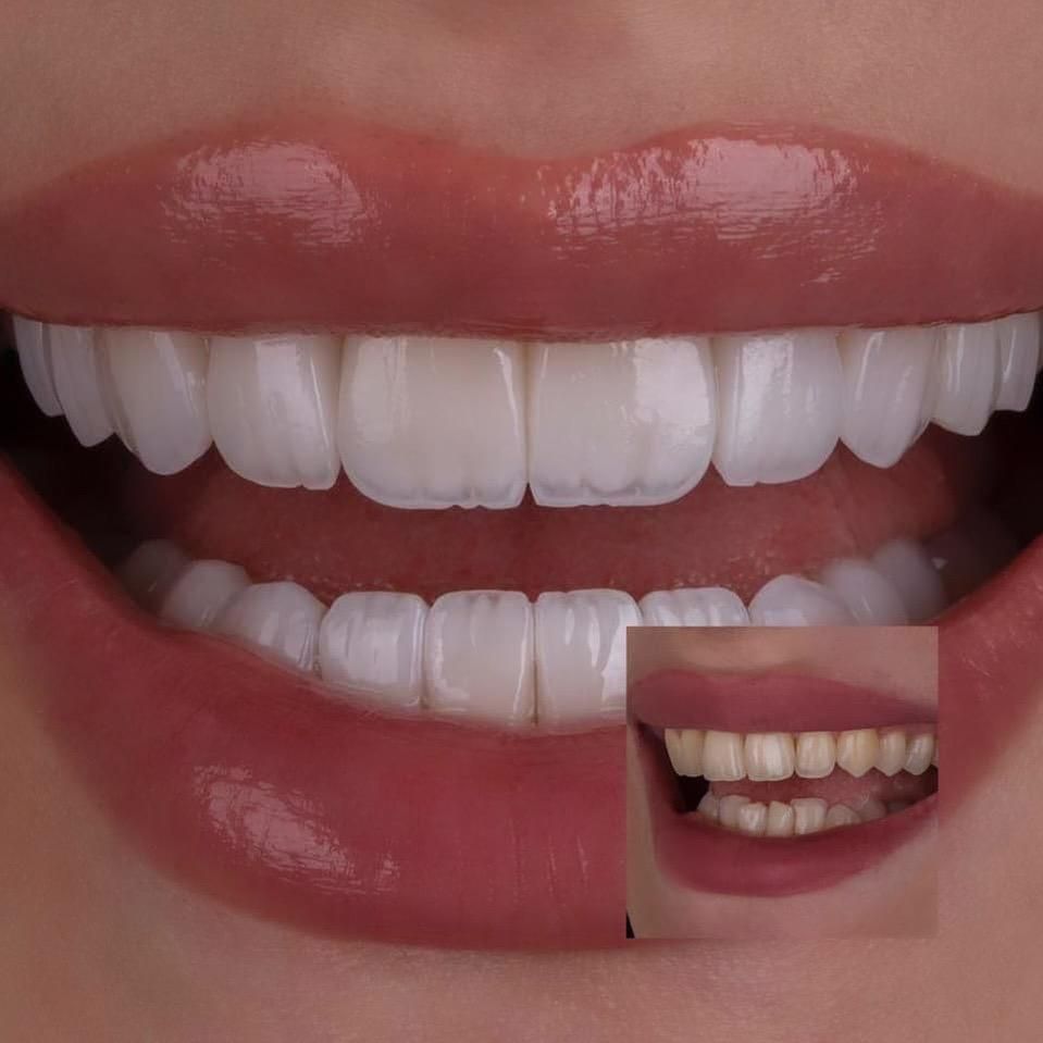روکش/وینر/لمینت/عصبکشی/خدمات دندانپزشکی ِ|خدمات آرایشگری و زیبایی|تبریز, |دیوار