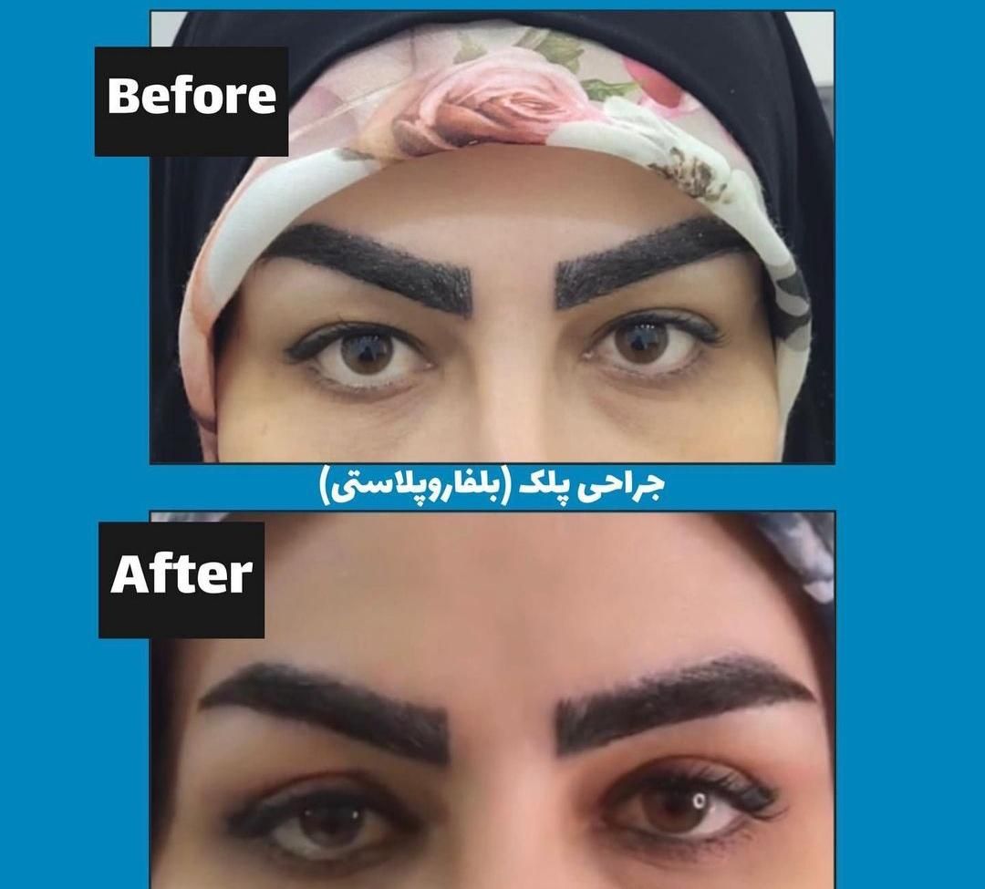 عمل جراحی پلک (بلفاروپلاستی)|خدمات آرایشگری و زیبایی|اصفهان, مسجد مصلی|دیوار