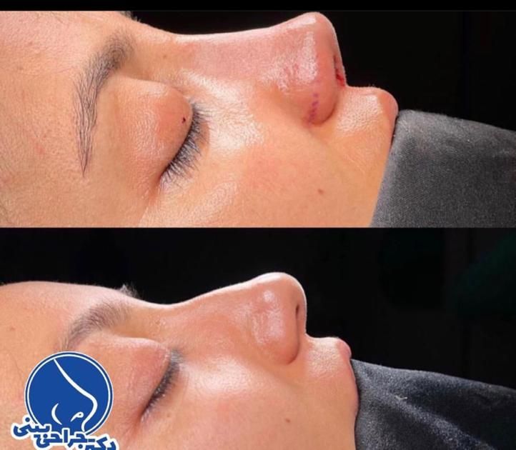 جراحی زیبایی بینی فقط با 22 میلیون|خدمات آرایشگری و زیبایی|قائم‌شهر, |دیوار