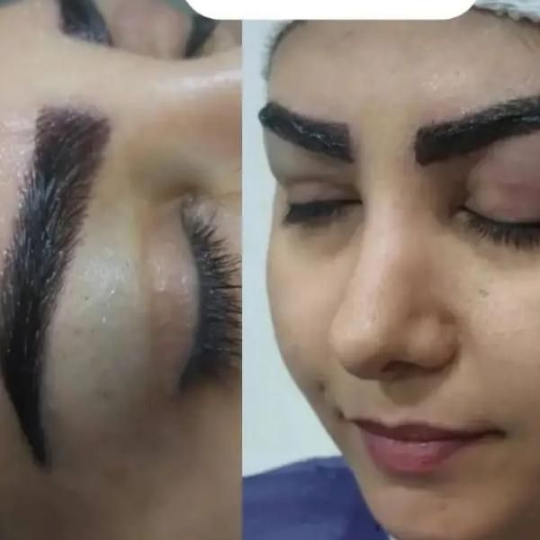 کاشت مو طبیعی دکتر رادمنش به روش سوپر sut|خدمات آرایشگری و زیبایی|اهواز, کیانپارس |دیوار