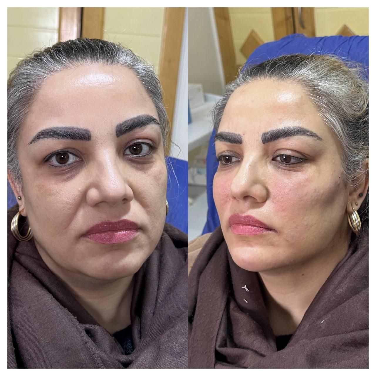 لیفت طبیعی کامل صورت ام دی کد کانتور صورت|خدمات آرایشگری و زیبایی|تهران, میرداماد|دیوار