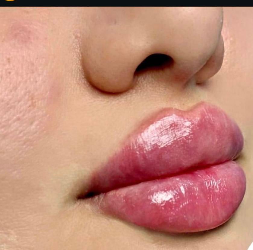 تزریق ژل بوتاکس پی ارپی درکلینیک|خدمات آرایشگری و زیبایی|کرمانشاه, |دیوار