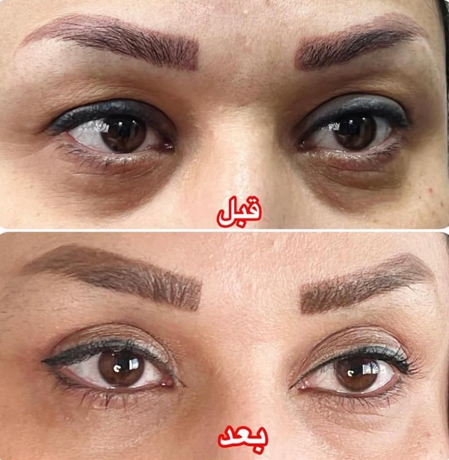 عمل بلفاروپلاستی درمان افتادگی پلک توسط متخصص چشم|خدمات آرایشگری و زیبایی|یاسوج, |دیوار