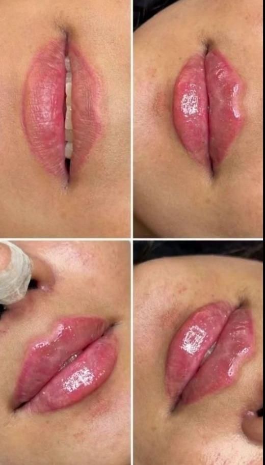 تزریق ژل و بوتاکس و فیلر زیر چشم ،نخ ،مزو ، آنزیم|خدمات آرایشگری و زیبایی|کرج, گوهردشت|دیوار