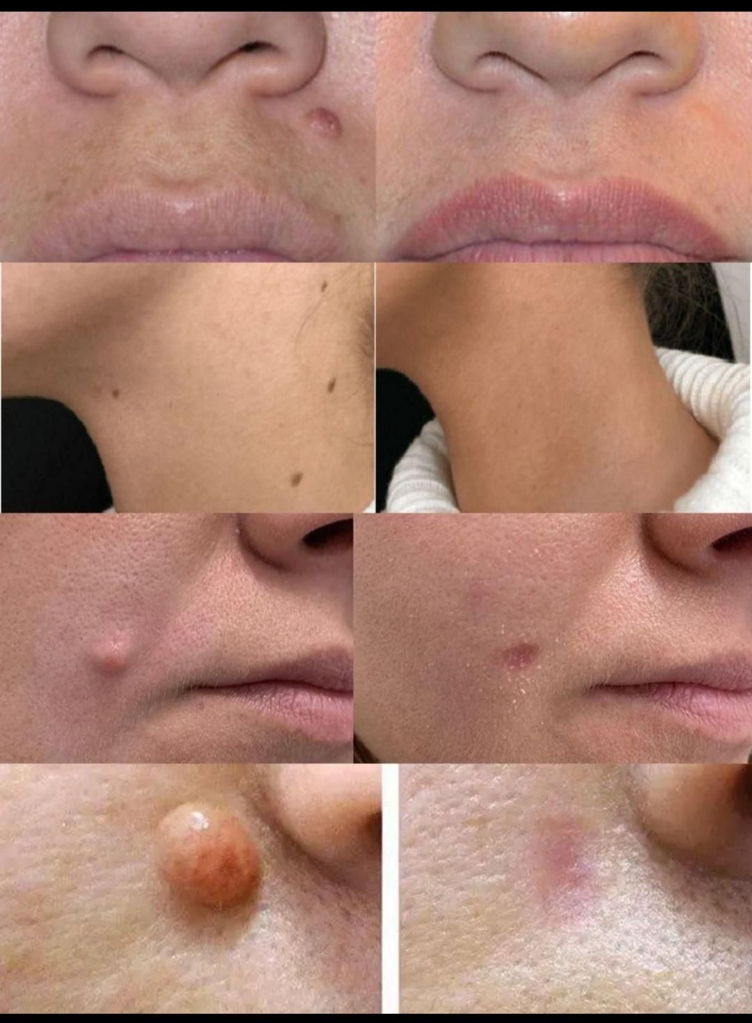 خال برداری کاملا بهداشتی وباوسایل یک بار مصرف|خدمات آرایشگری و زیبایی|قم, امامزاده ابراهیم|دیوار