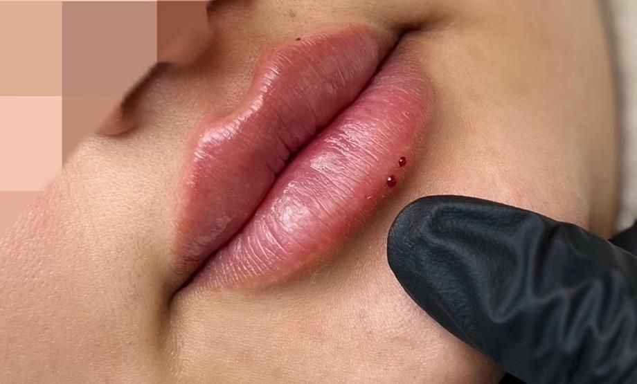 مطب تخفیف ژل و فیلر لب و صورت و بوتاکس|خدمات آرایشگری و زیبایی|قم, صفائیه|دیوار